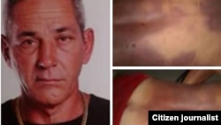 Alejandro Pupo Echemendía. A la derecha, fotos tomadas por sus familiares con las huellas de una golpiza policial que recibió en Placetas y acabó con su vida.