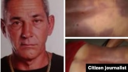 Alejandro Pupo Echemendía. A la derecha, fotos tomadas por sus familiares con huellas de la golpiza policial que recibió en Placetas y acabó con su vida.